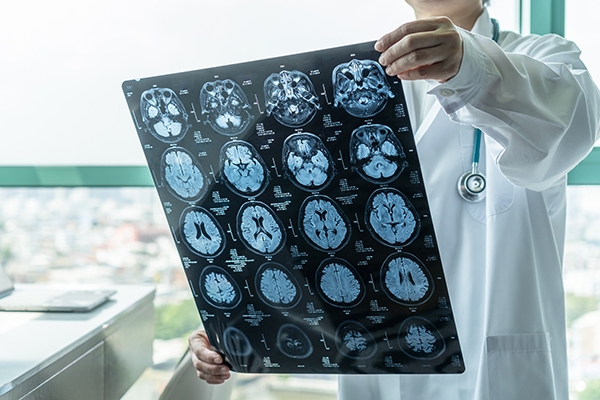 Doctor looking at MRI film that shows elderly patient with neurodegenerative illness.