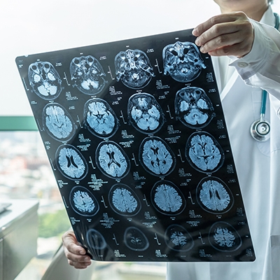 Doctor looking at MRI film that shows elderly patient with neurodegenerative illness.
