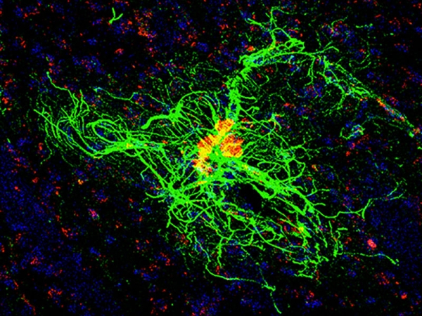 Astrocytes and amyloid plaques.