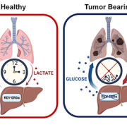 Illustration of lung cancer progression