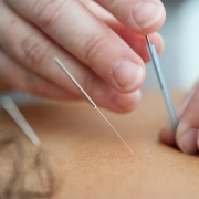 Close-up view of a person's hands conducting acupuncture. 