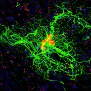 Astrocytes and amyloid plaques.