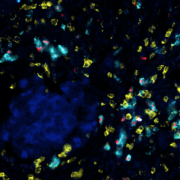 CD8+ T cells (yellow) activated by PD-1 blockade also interact with T regulatory cells (teal and red), which subsequently dampen the immune response against the melanoma tumor cells (blue).