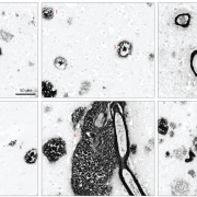 High magnification of different amyloid deposits recognized by lecanemab