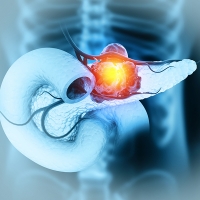 Pancreatic cancer is cancer that forms in the cells of the pancreas. 3d illustration stock photo