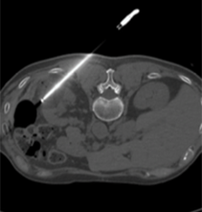 Cryoablation probe in the renal mass with surrounding low density ice ball showing the area of ablation.