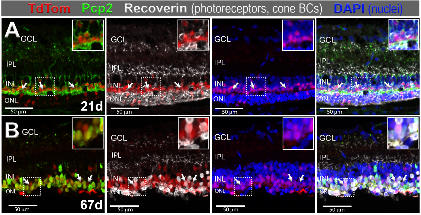 Red fluorescent TdTomato-labeled cells in retina of transgenic rat at 2 different ages, showing continued photoreceptor degeneration. Additional markers depict the identity of the TdTomato-labeled cells. 