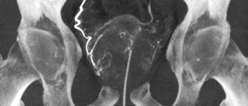Prostatic Artery Embolization